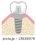 歯 インプラント 構造 名称のイラスト素材