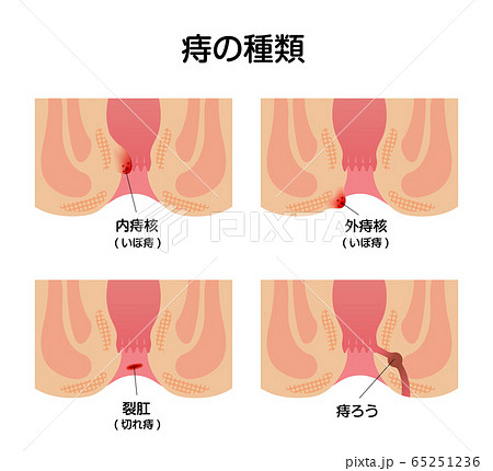 いぼ痔のイラスト素材