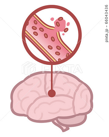 脳出血のイラスト素材
