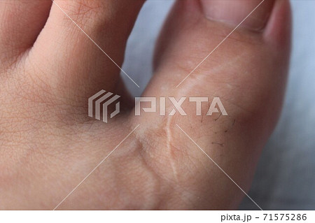 皮膚線状 痕 人物の写真素材