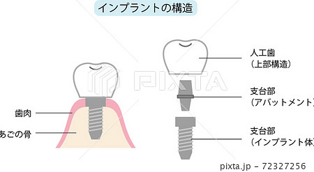 インプラントの写真素材 インプラントの写真素材