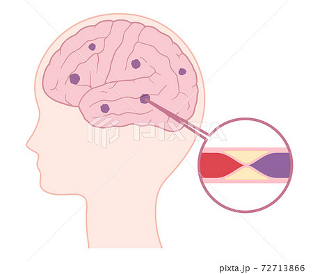脳血管障害のイラスト素材