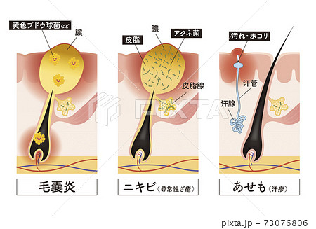 埋もれ毛の写真素材