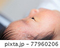 脂漏性湿疹 頭皮湿疹の写真素材 [41989310] - PIXTA