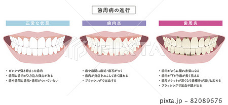 歯周病のイラスト素材