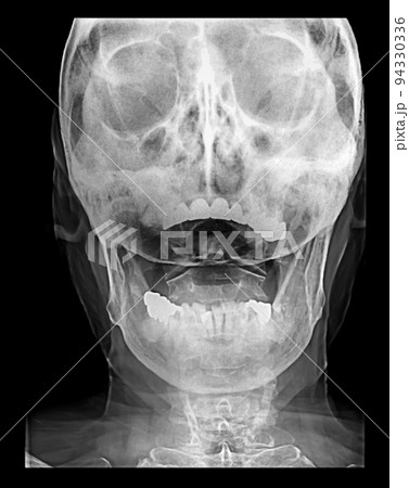 レントゲン レントゲン写真 頭 頭蓋骨の写真素材 - PIXTA