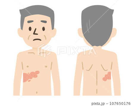 Upper back of young woman contracted chickenpox and red rash